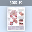 Плакат «Хроническая обструктивная болезнь легких (ХОБЛ)» (ЗОЖ-49, пластик 2 мм, А1, 1 лист)
